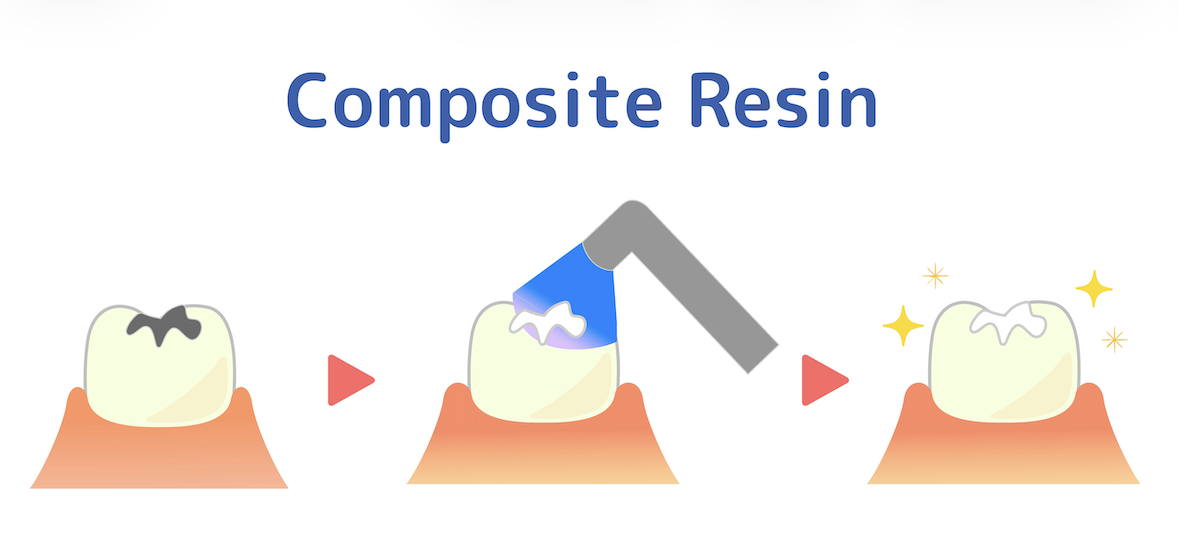 複合樹脂 (Composite Resin) 補牙物料示意圖
